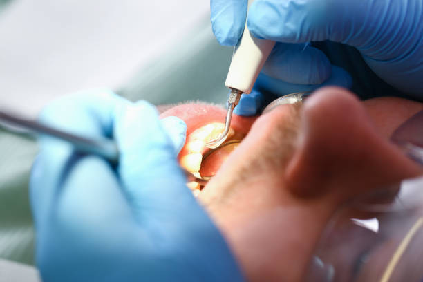 Best Emergency Root Canal Treatment in Narrows, VA